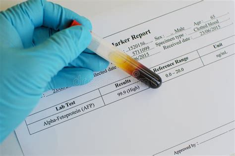 AFP positive stock image. Image of health, illness, analyzing - 57034881