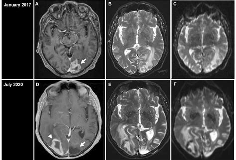 Post Gadolinium Magnetic Resonance Imaging Mri T1 Download Scientific Diagram