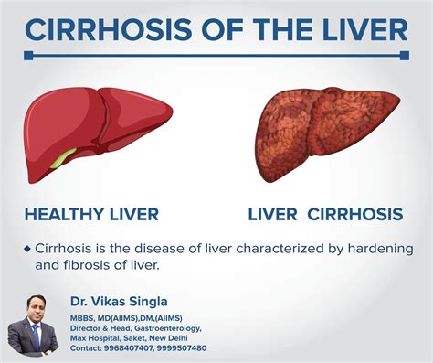 Cirrhosis: Causes, Symptoms & Treatments - Gastron