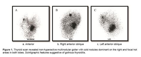 Goiter Hypothyroidism