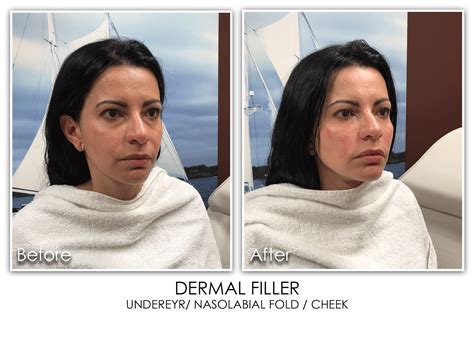 Nasolabial Fold Archives Skin Rejuvenation Clinic Skin Rejuvenation