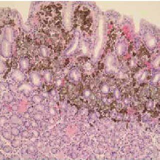 Endoscopic images of the primary malignant melanoma of stomach ...