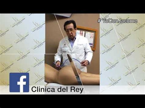 Implante De Gl Teos Cl Nica Del Rey Del Dr Franco Reyes J Come Youtube