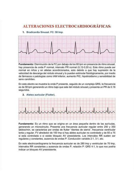 Alteraciones Electrocardiogr Ficas Espm Medicina Udocz