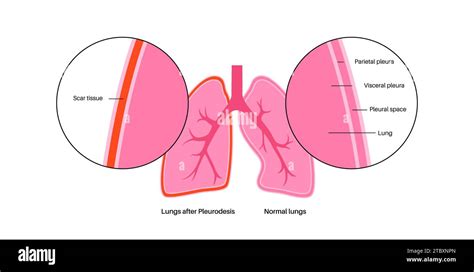 Pleurodesis medical procedure, illustration Stock Photo - Alamy