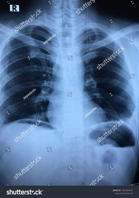 Gas Under Diaphragm Stock Photos and Pictures - 33 Images | Shutterstock