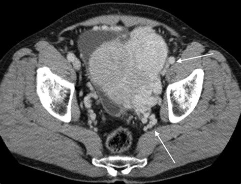 Solitary Fibrous Tumors Of The Soft Tissues Review Of The Imaging And