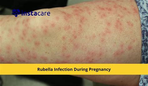 What You Must Know About Rubella Infection During Pregnancy