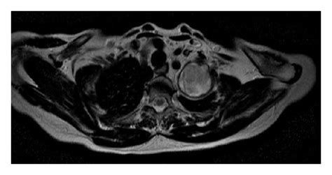 Brachial Plexus Axial MRI