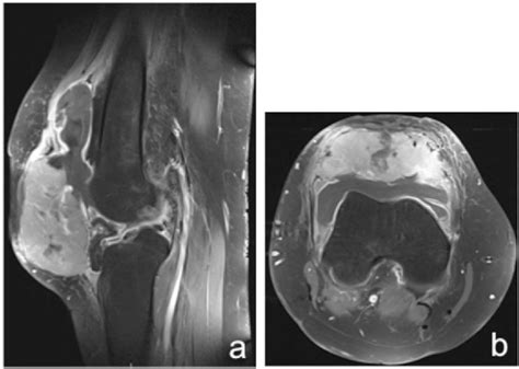 Figure 1 From Pathologic Fracture Of A Giant Cell Tumour Of The Patella