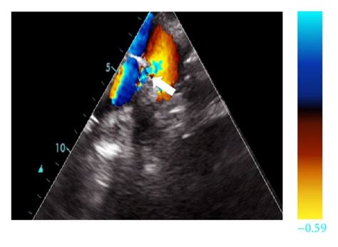 Colour Doppler Images From The Transthoracic Echocardiogram Show