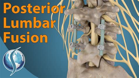 Posterior Lumbar Fusion Youtube