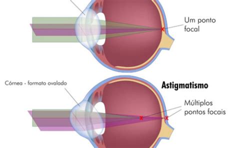 Astigmatismo COHR Oftalmologia