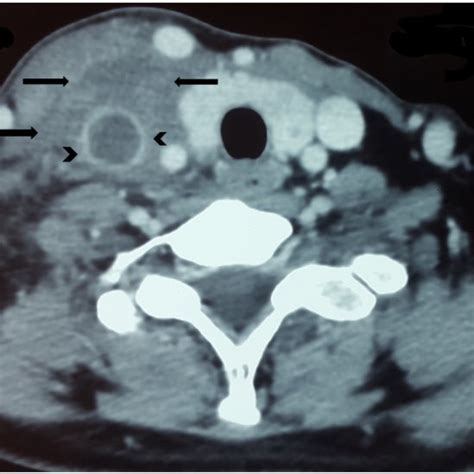 On Axial Contrast Enhanced Computed Tomography Scan An Abnormal Low