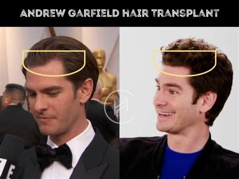 Andrew Garfield Hair Transplant Hair Loss And Technical Analysis