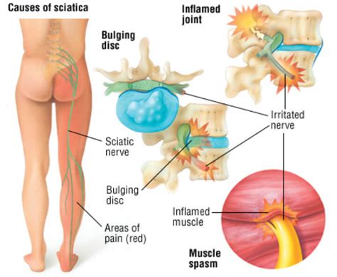 St. Louis Sciatica Pain Relief - Citrin Chiropractic Center