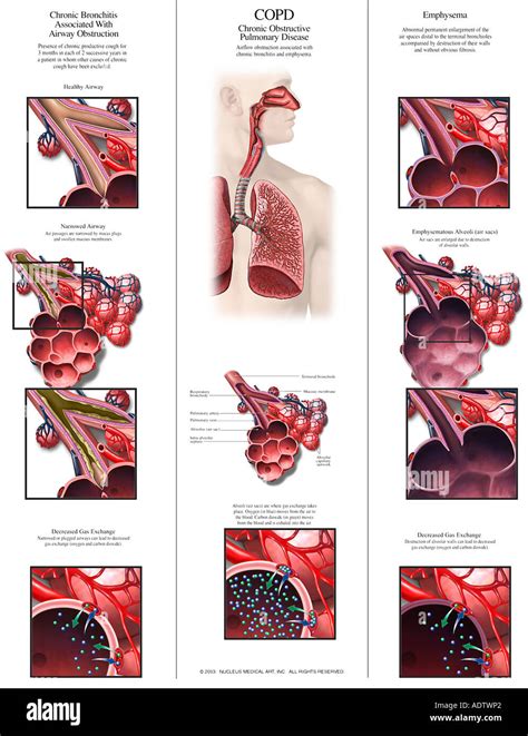 Copd Chronisch Obstruktive Lungenerkrankung Stockfotografie Alamy