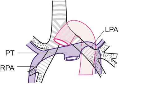 Techniques Of Linear Endobronchial Ultrasound Intechopen