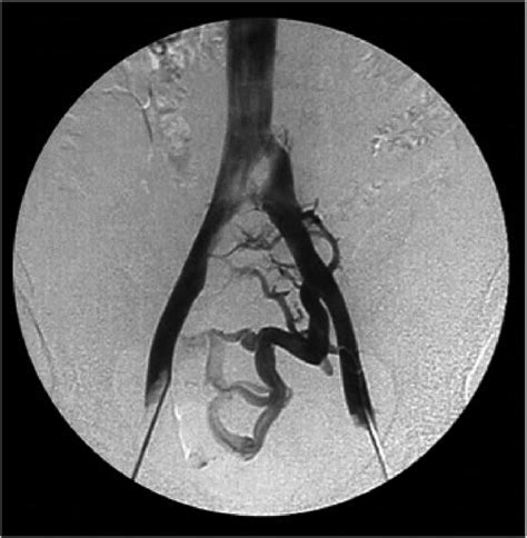 9 Venography Using Bilateral Femoral Access Compression Of The Left