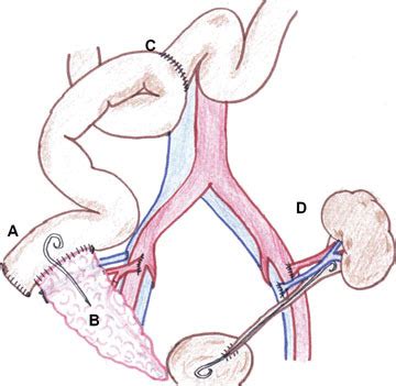 Pancreas Graft Salvage Using Pancreaticoduodenectomy With Enteric