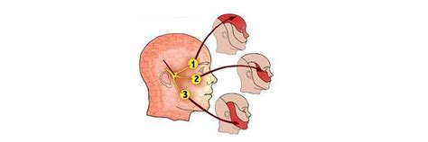 Que es la neuralgia de trigémino y su tratamiento de fisioterapia en