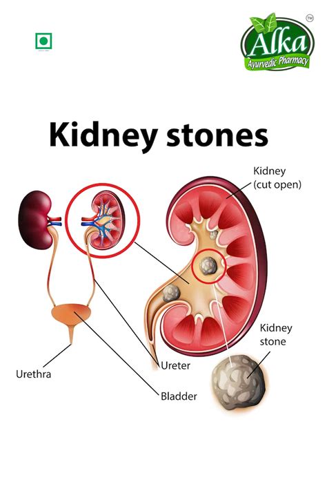 Kidney Stone Removal Powder