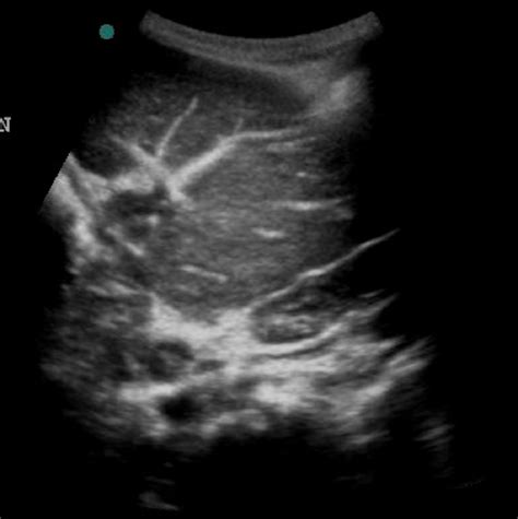 Figure 2 From Imaging Appearance Of Gamna Gandy Bodies Semantic Scholar