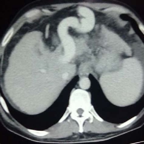 Intra operative image of large recanalized para umbilical vein in ...