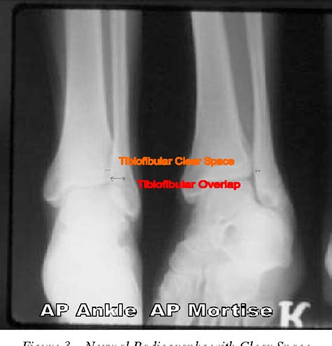 Figure 1 From Rehabilitation Of Distal Tibiofibular Syndesmosis Sprains