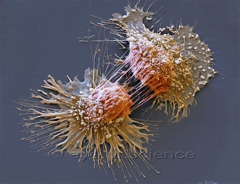 Skin Cancer Cells Under Microscope