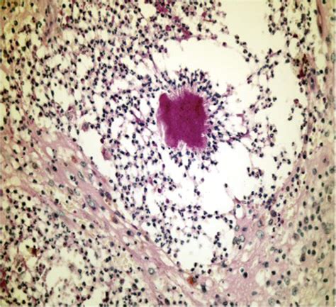 Actinomycosis Report Of A Case With A Persistent Extraoral Sinus Tract Oral Surgery Oral