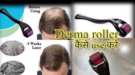 Derma Roller For Hair Growth Derma Roller का उपयोग कैसे करें Does Micro Needling Actually