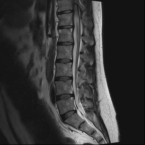 Romanus Lesions Ankylosing Spondylitis Image