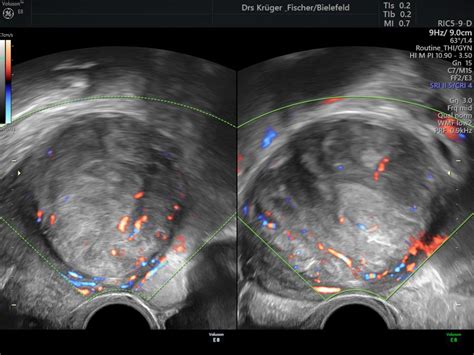 Uterus Galerie Fach Rzte F R Frauenheilkunde Bielefeld Kr Ger Fischer