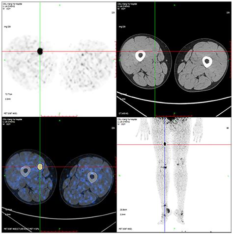 Phosphaturic Mesenchymal Tumor In Right Thigh Cases Report And