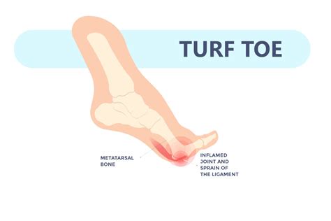 Turf Toe Pain In Bone: Turf Toe Surgery – WLWPUF
