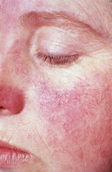 Lupus Vasculitis Rash