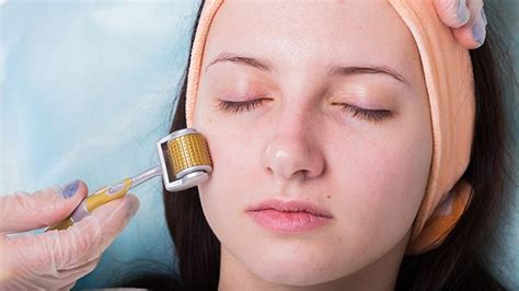 Benefits and Side Effects of Microneedling - Fashioning The New