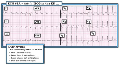 Dr Smiths Ecg Blog Why Is There St Depression In Avl In This Case Of 31b