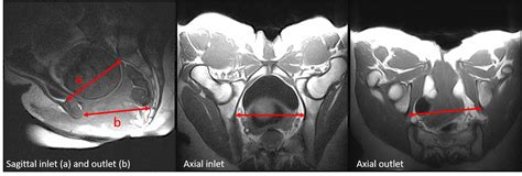 Pelvic Inlet And Outlet Views