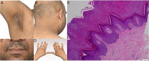 Acanthosis Nigricans Of Axillae A Neck B Lips C Dorsal Hands