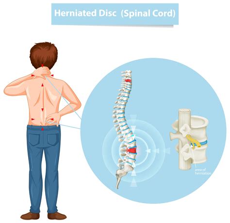 Disc Herniation Dr Emily Warren Physical Therapy