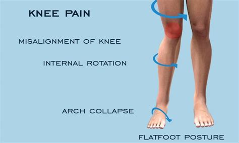 What Are The Effects Of Flat Feet On Knee Pain Fitpaa