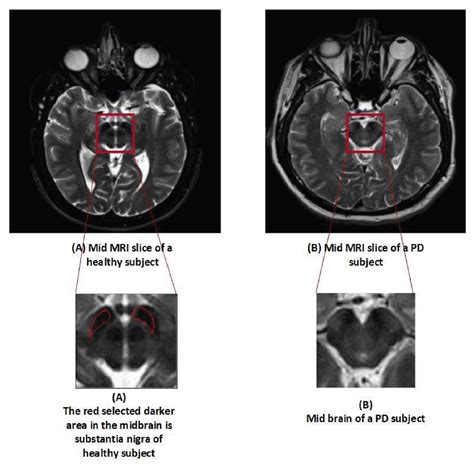 Diagnostics Free Full Text Classification Of Parkinsons Disease In Patch Based Mri Of