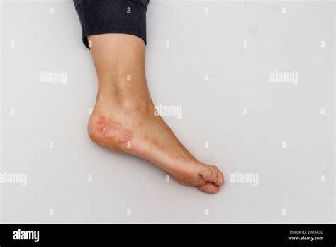 Dyshidrotic Eczema Feet