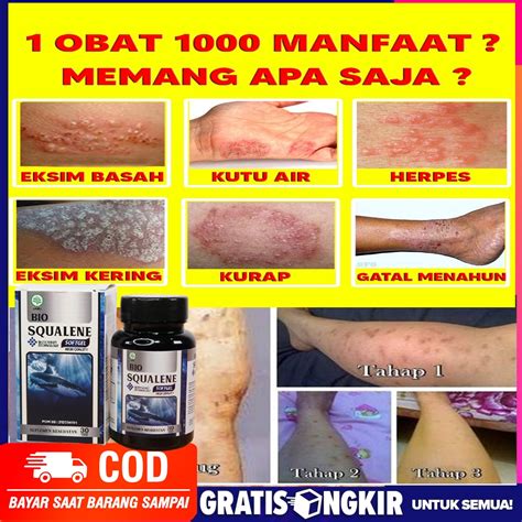 Obat Gatal Kulit Budug Obat Gatal Di Seluruh Tubuh Scabies Pada