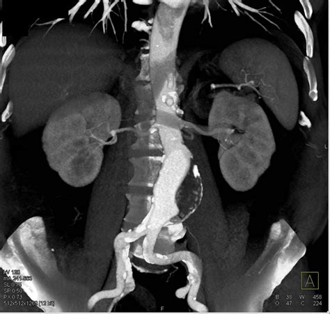 Abdominal Aorta Ct Scan