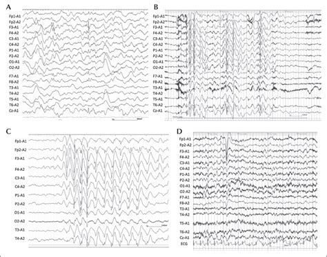 JLE Epileptic Disorders Pharmacoresistant Epileptic Eyelid