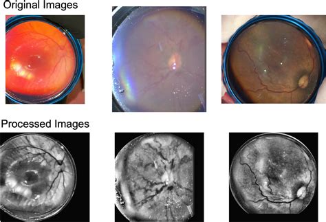 Image Harmonization And Deep Learning Automated Classification Of Plus