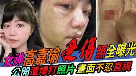 女神高嘉瑜受傷照全曝光 畫面不忍直視｜毆打原因匪夷所思 遭抓髮拖行｜施暴過程 入住飯店員工視若無睹｜醫院驗傷 醫生都感嘆前所未見｜呱呱新聞 Youtube